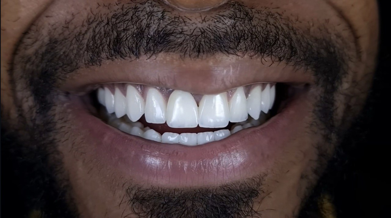 تركيبات الأسنان