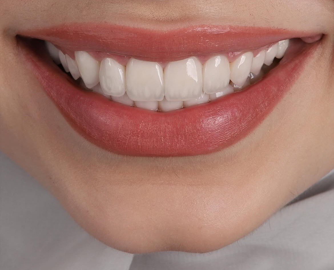 ابتسامة هوليوود